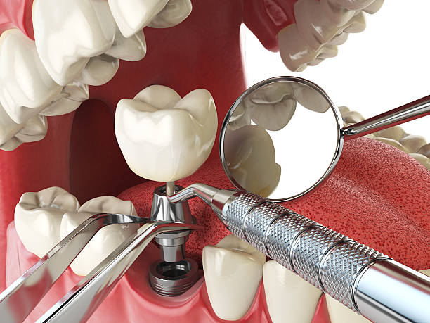 Best Emergency Treatment for Dental Infections or Abscesses in Bozeman, MT